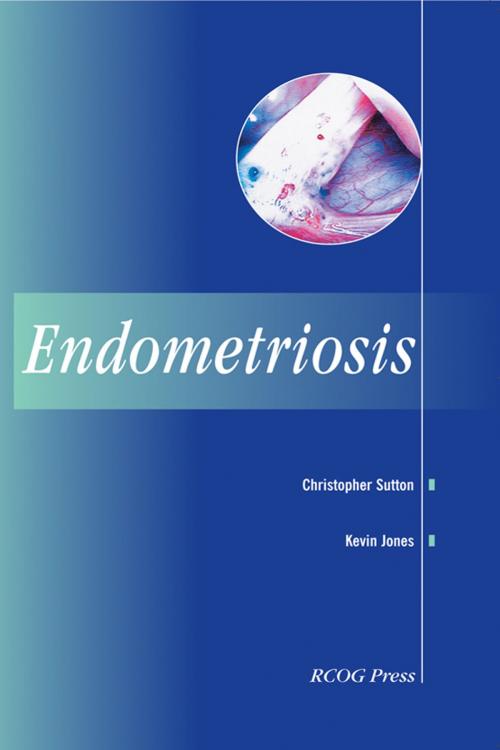 Cover of the book Endometriosis by Christopher Sutton, Kevin Jones, Royal College of Obstetricians and Gynaecologists (RCOG)