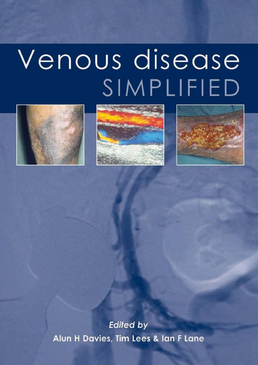 Big bigCover of Venous Disease Simplified
