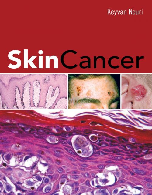 Cover of the book Skin Cancer by Keyvan Nouri, McGraw-Hill Education