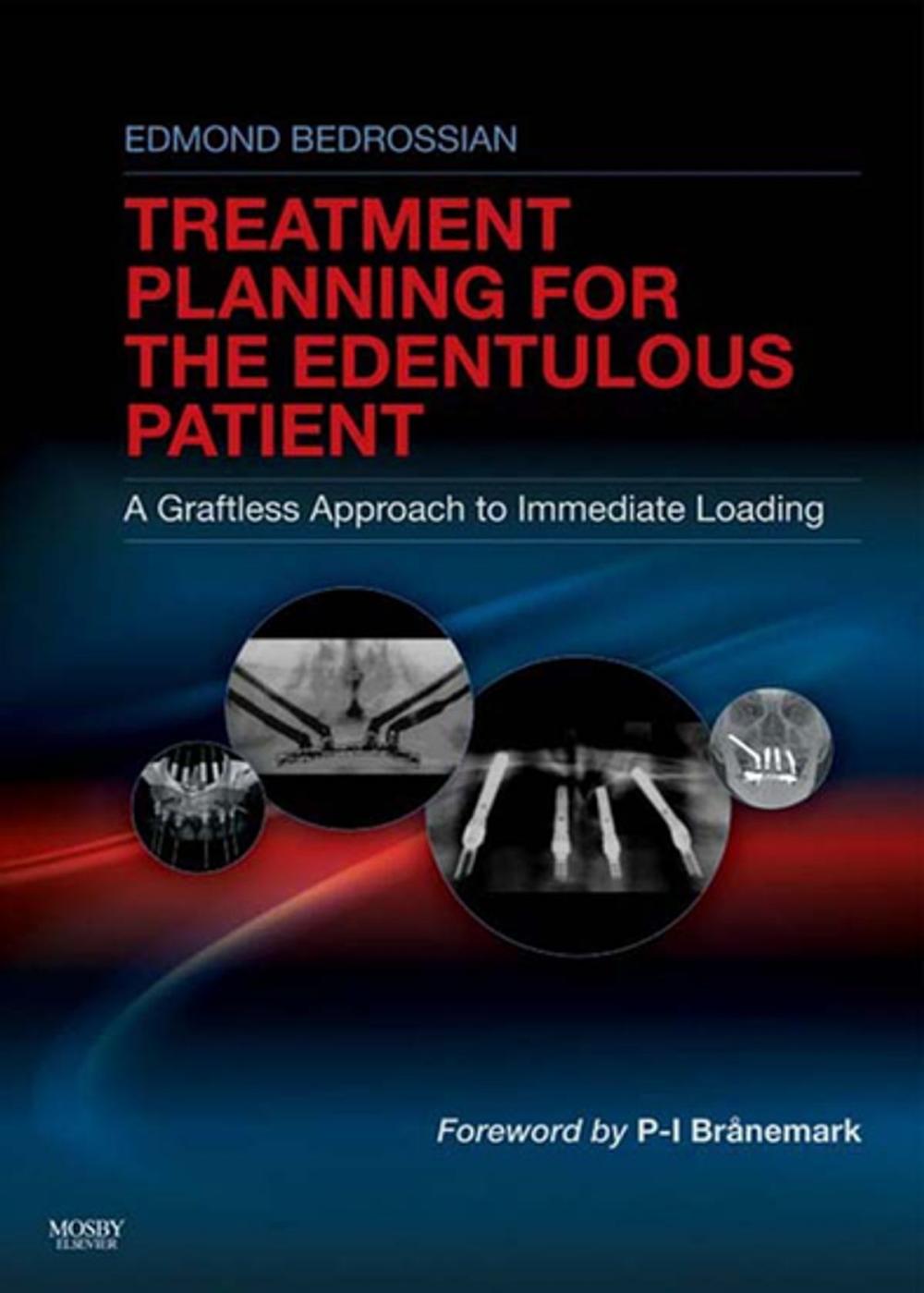 Big bigCover of Implant Treatment Planning for the Edentulous Patient