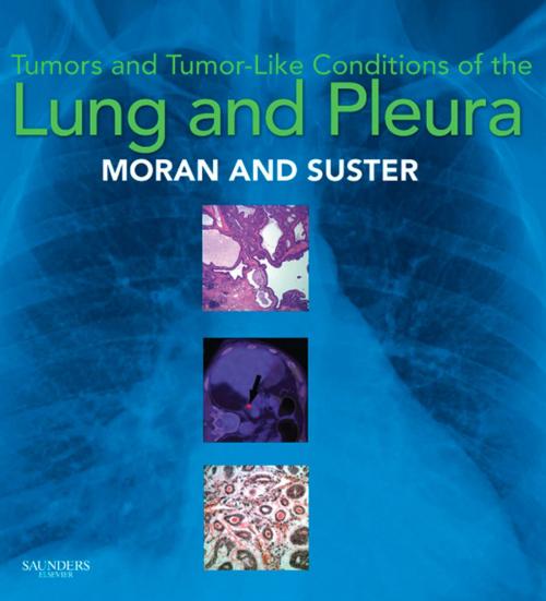 Cover of the book Tumors and Tumor-like Conditions of the Lung and Pleura E-Book by Cesar A. Moran, MD, Saul Suster, MD, Elsevier Health Sciences