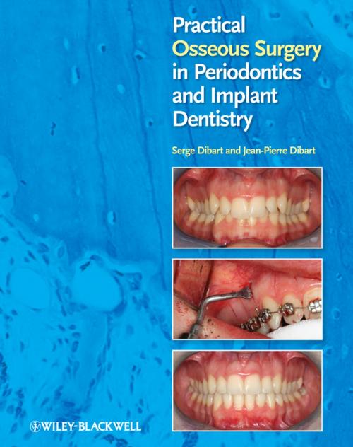 Cover of the book Practical Osseous Surgery in Periodontics and Implant Dentistry by Serge Dibart, Jean-Pierre Dibart, Wiley