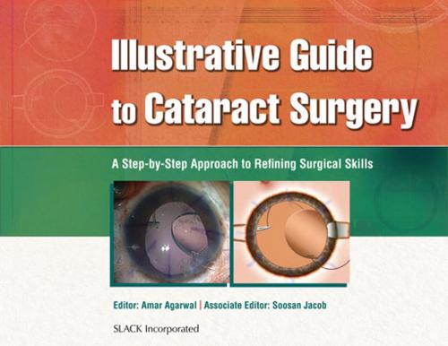 Cover of the book Illustrative Guide to Cataract Surgery by , SLACK Incorporated