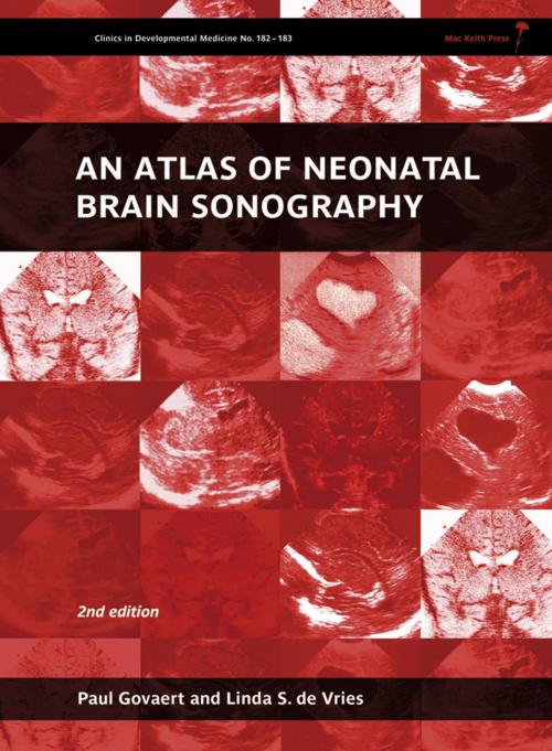 Cover of the book An Atlas of Neonatal Brain Sonography, 2nd Edition by Paul Govaert, Linda S de Vries, Mac Keith Press
