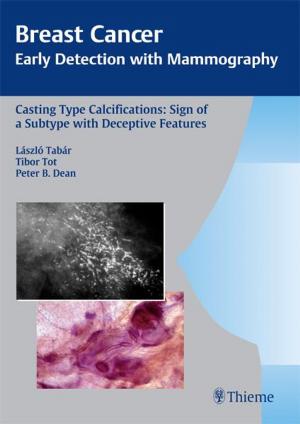 Cover of the book Casting Type Calcifications: Sign of a Subtype with Deceptive Features by Juergen Theissing, Gerhard Rettinger