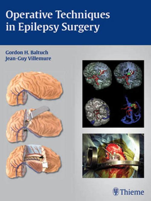 Cover of the book Operative Techniques in Epilepsy Surgery by , Thieme