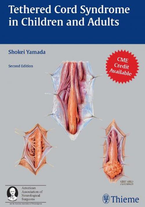 Cover of the book Tethered Cord Syndrome in Children and Adults by , Thieme