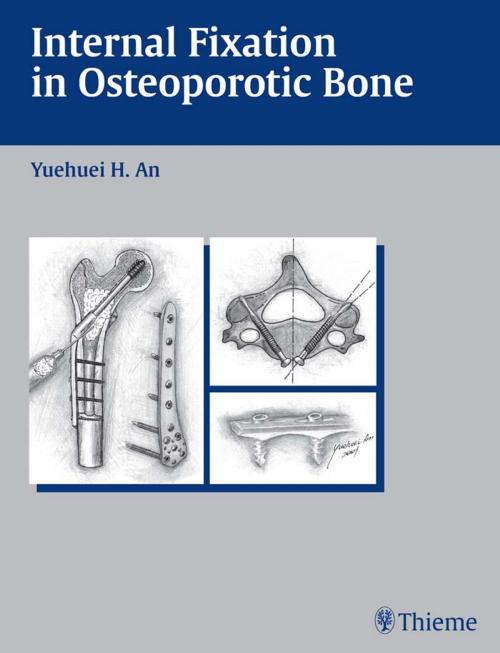 Cover of the book Internal Fixation in Osteoporotic Bone by , Thieme