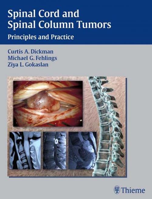 Cover of the book Spinal Cord and Spinal Column Tumors by , Thieme