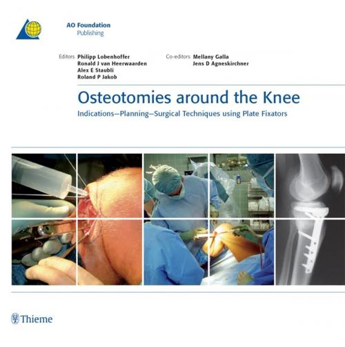 Cover of the book Osteotomies around the Knee by Philipp Lobenhoffer, Ronald J. van Heerwaarden, Alex E. Staubli, Thieme/AO