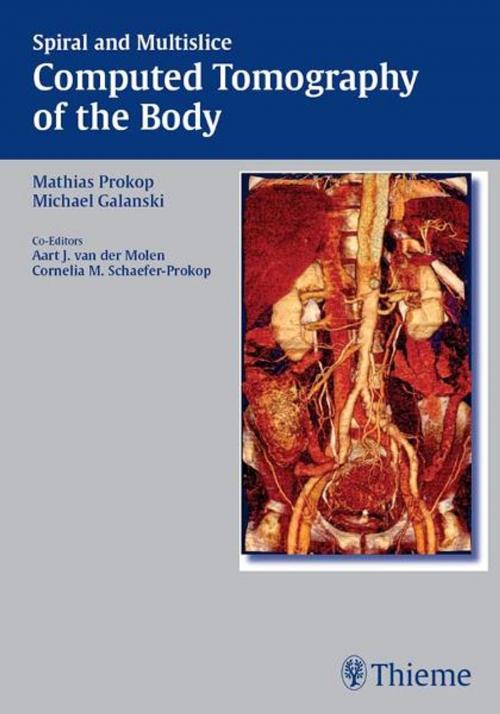 Cover of the book Spiral and Multislice Computed Tomography of the Body by Mathias Prokop, Michael Galanski, Thieme