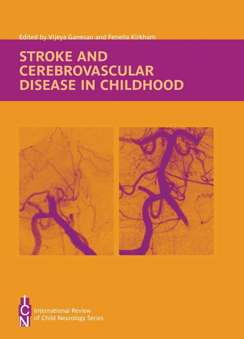 Big bigCover of Stroke and Cerebrovascular Disease in Childhood