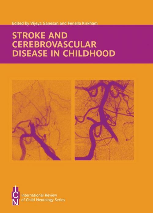 Cover of the book Stroke and Cerebrovascular Disease in Childhood by , Mac Keith Press