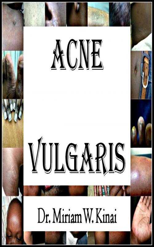 Cover of the book Acne Vulgaris by Miriam Kinai, Miriam Kinai