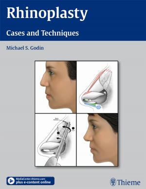 Cover of the book Rhinoplasty by Guenter Schmidt, Lucas Greiner, Dieter Nuernberg