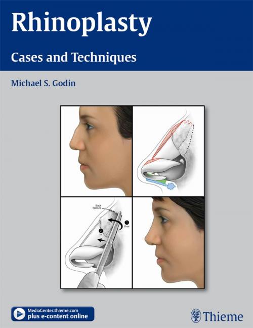 Cover of the book Rhinoplasty by Michael S. Godin, Thieme