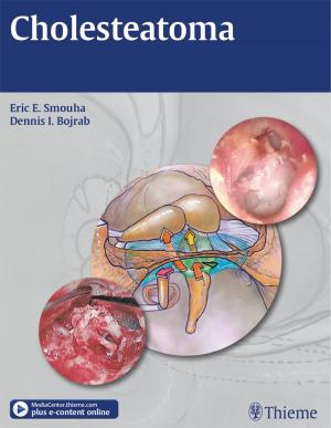Cover of the book Cholesteatoma by Roger TannerThies