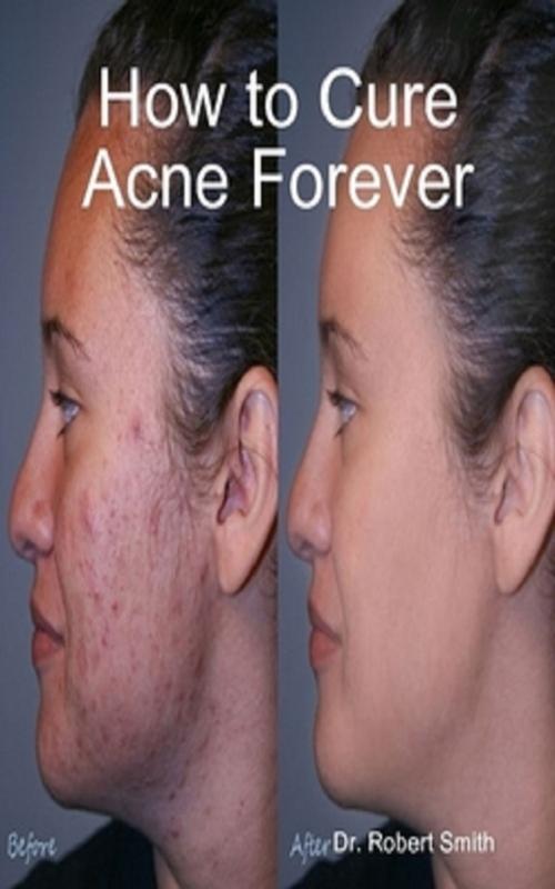 Cover of the book How to Cure Acne Forever by Dr. Robert Smith, Green King Press