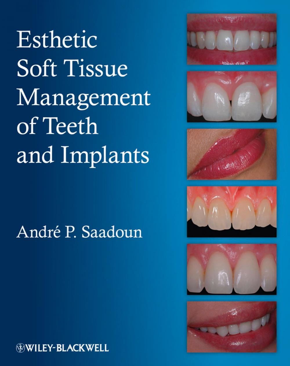 Big bigCover of Esthetic Soft Tissue Management of Teeth and Implants