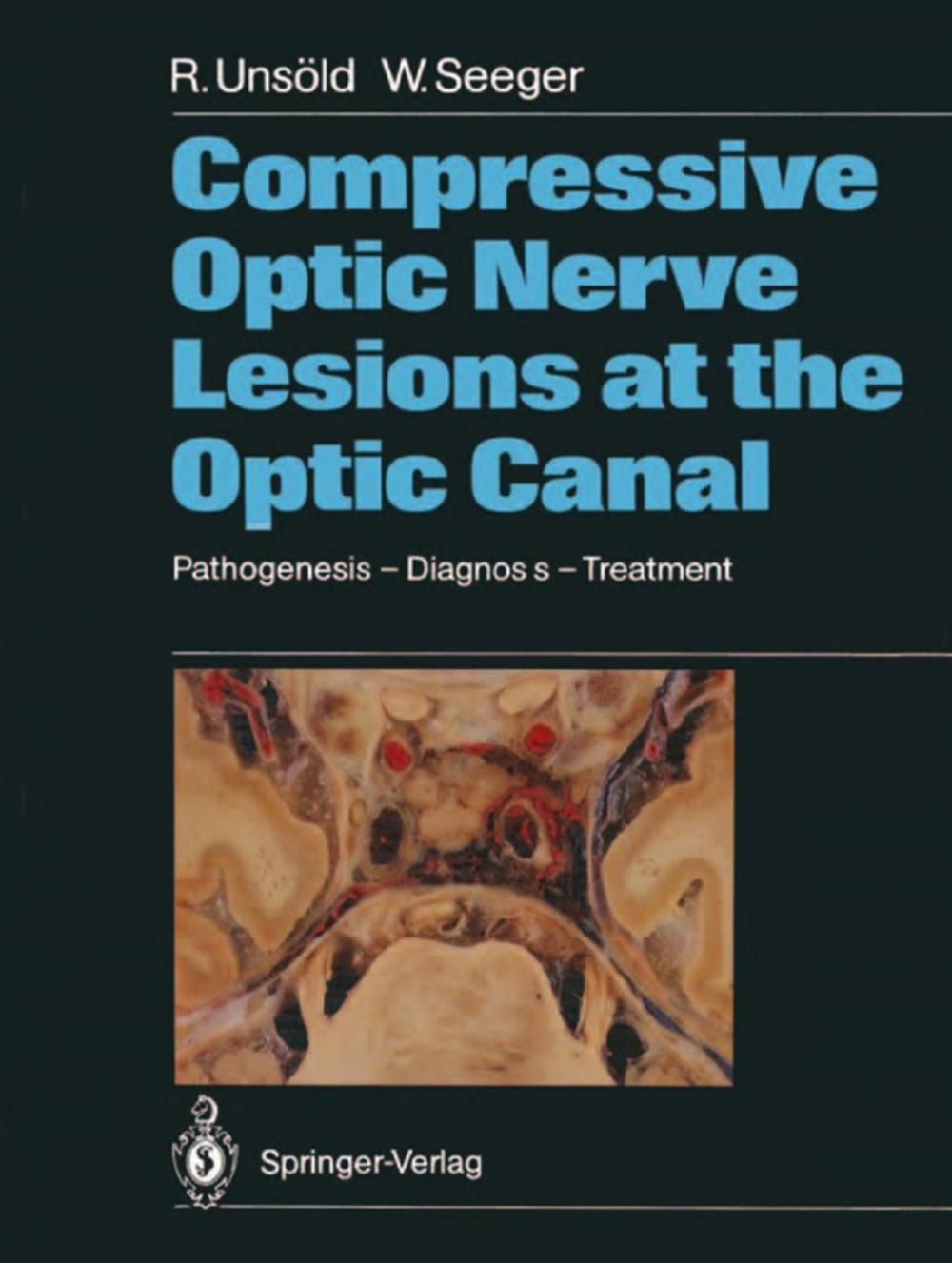 Big bigCover of Compressive Optic Nerve Lesions at the Optic Canal