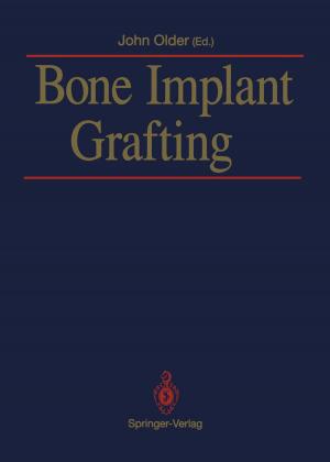 Cover of the book Bone Implant Grafting by Morris F. Collen