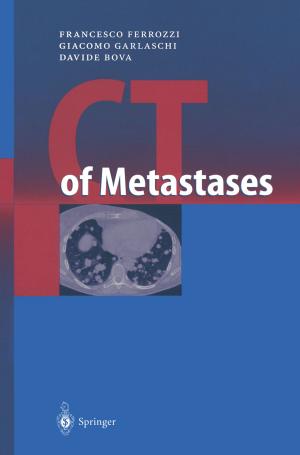 Cover of the book CT of Metastases by G. Abel, R. Bos, I.H. Bowen, R.F. Chandler, D. Corrigan, I.J. Cubbin, P.A.G.M: De Smet, N. Pras, J-.J.C. Scheffer, T.A. Van Beek, W. Van Uden, H.J. Woerdenbag