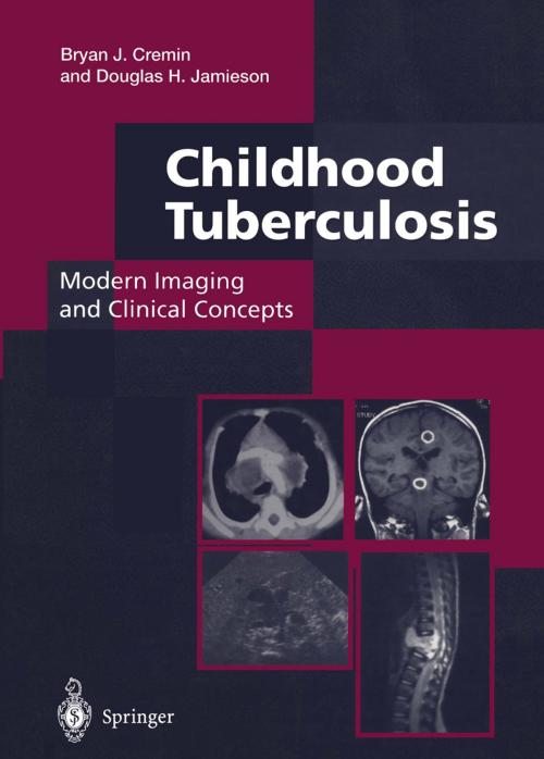 Cover of the book Childhood Tuberculosis: Modern Imaging and Clinical Concepts by Bryan J. Cremin, Douglas H. Jamieson, Springer London