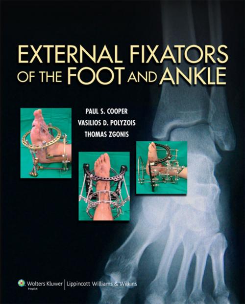Cover of the book External Fixators of the Foot and Ankle by Paul Cooper, Thomas Zgonis, Vasilios Polyzois, Wolters Kluwer Health