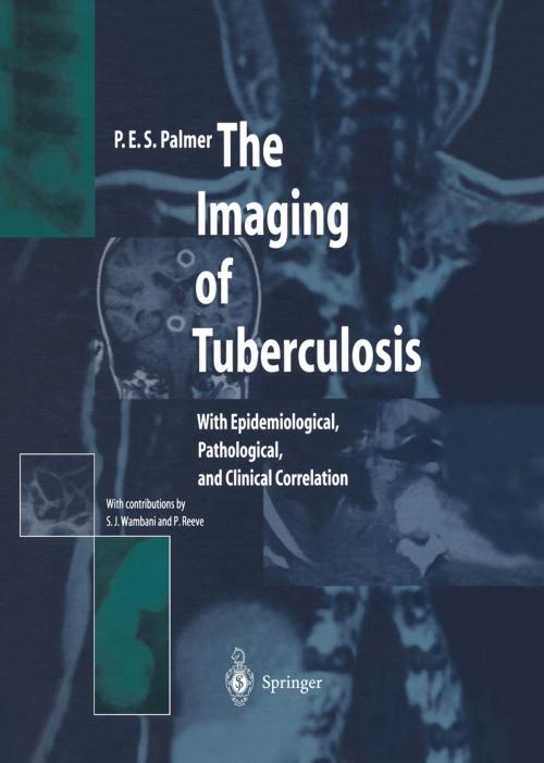 Cover of the book The Imaging of Tuberculosis by P.E.S. Palmer, P. Reeve, S.J. Wambani, Springer Berlin Heidelberg