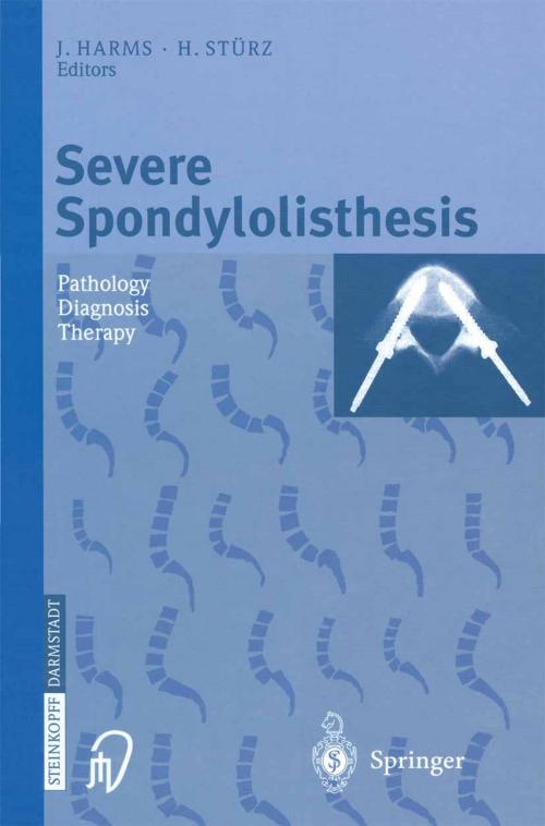 Cover of the book Severe Spondylolisthesis by , Steinkopff