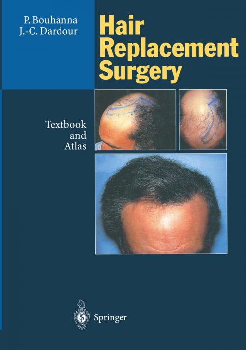 Cover of the book Hair Replacement Surgery by Pierre Bouhanna, Jean-Claude Dardour, Springer Berlin Heidelberg