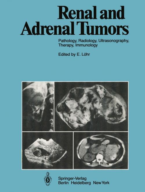 Cover of the book Renal and Adrenal Tumors by R. Ackerman, D. Bachmann, A. Baert, H. Behrendt, D. Beyer, W. Bischoff, E. Boijsen, H.C. Dominick, V. Fiedler, W.A. Fuchs, M. Georgi, U. Goerttler, M. Goldberg, R. Günther, W. Havers, R. Heckmann, H. Holfeld, L. Jeanmart, J.V. Kaude, L.D. Leder, E. Löhr, M. Marberger, G. Marchal, P. Mellin, A. Moss, O. Olsson, M. Osteaux, H.J. Richter, E. Scherer, C. Stambolis, M.W. Strötges, B. Swart, Guido Wilms, Springer Berlin Heidelberg