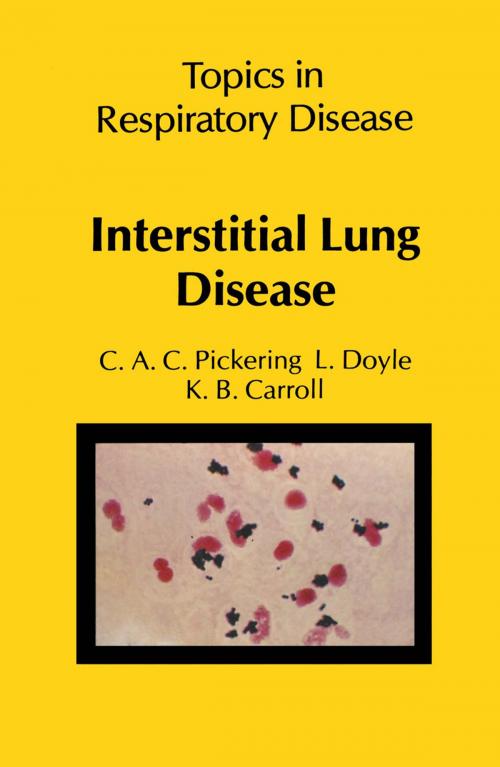 Cover of the book Interstitial Lung Disease by C.A.C. Pickering, L. Doyle, K.B. Carroll, Springer Netherlands