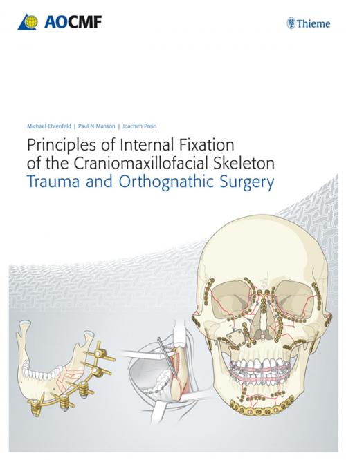 Cover of the book Principles of Internal Fixation of the Craniomaxillofacial Skeleton by Michael Ehrenfeld, Paul N. Manson, Joachim Prein, Thieme/AO