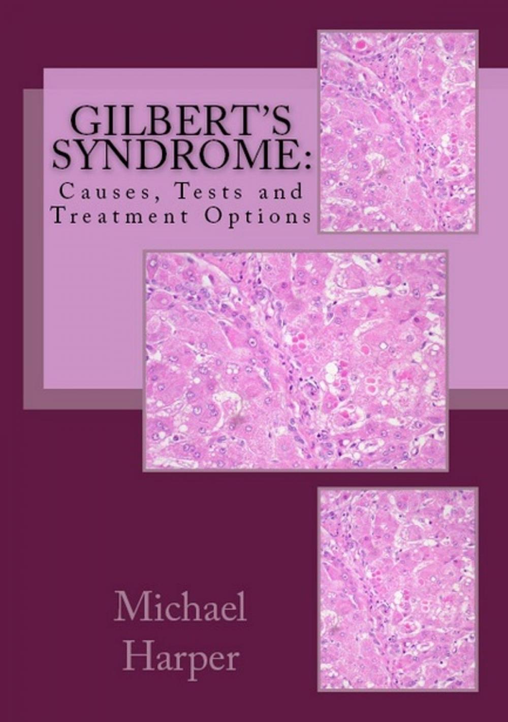 Big bigCover of Gilbert's Syndrome: Causes, Tests and Treatment Options