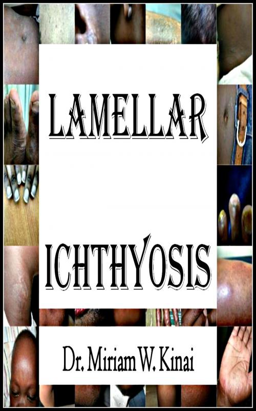 Cover of the book Lamellar Ichthyosis by Miriam Kinai, Miriam Kinai