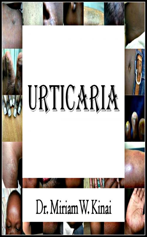 Cover of the book Urticaria by Miriam Kinai, Miriam Kinai