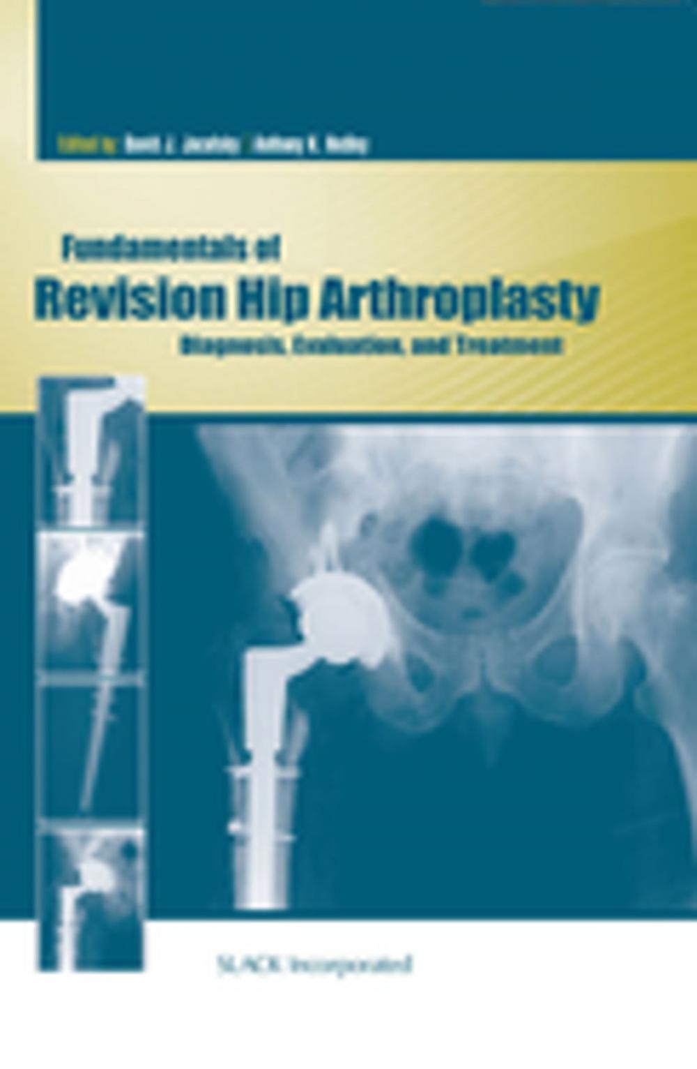 Big bigCover of Fundamentals of Revision Hip Arthroplasty