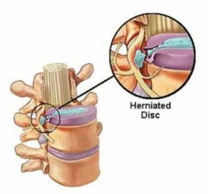 Cover of the book An Informative Guide About Herniated Disks by Sally Fletcher