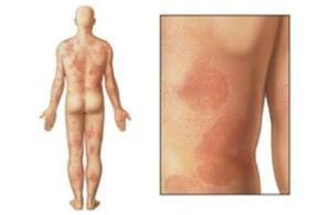 Cover of Chronic Hives: Causes, Symptoms and Treatments
