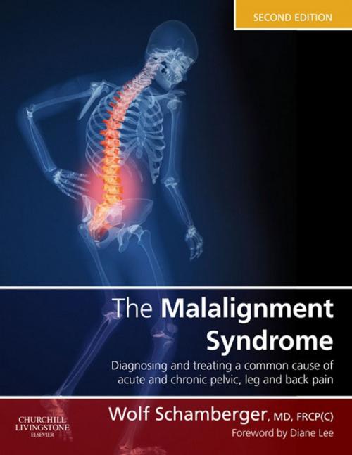 Cover of the book The Malalignment Syndrome E-Book by Wolf Schamberger, Elsevier Health Sciences