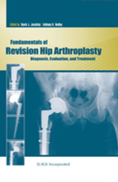 Cover of the book Fundamentals of Revision Hip Arthroplasty by , SLACK Incorporated