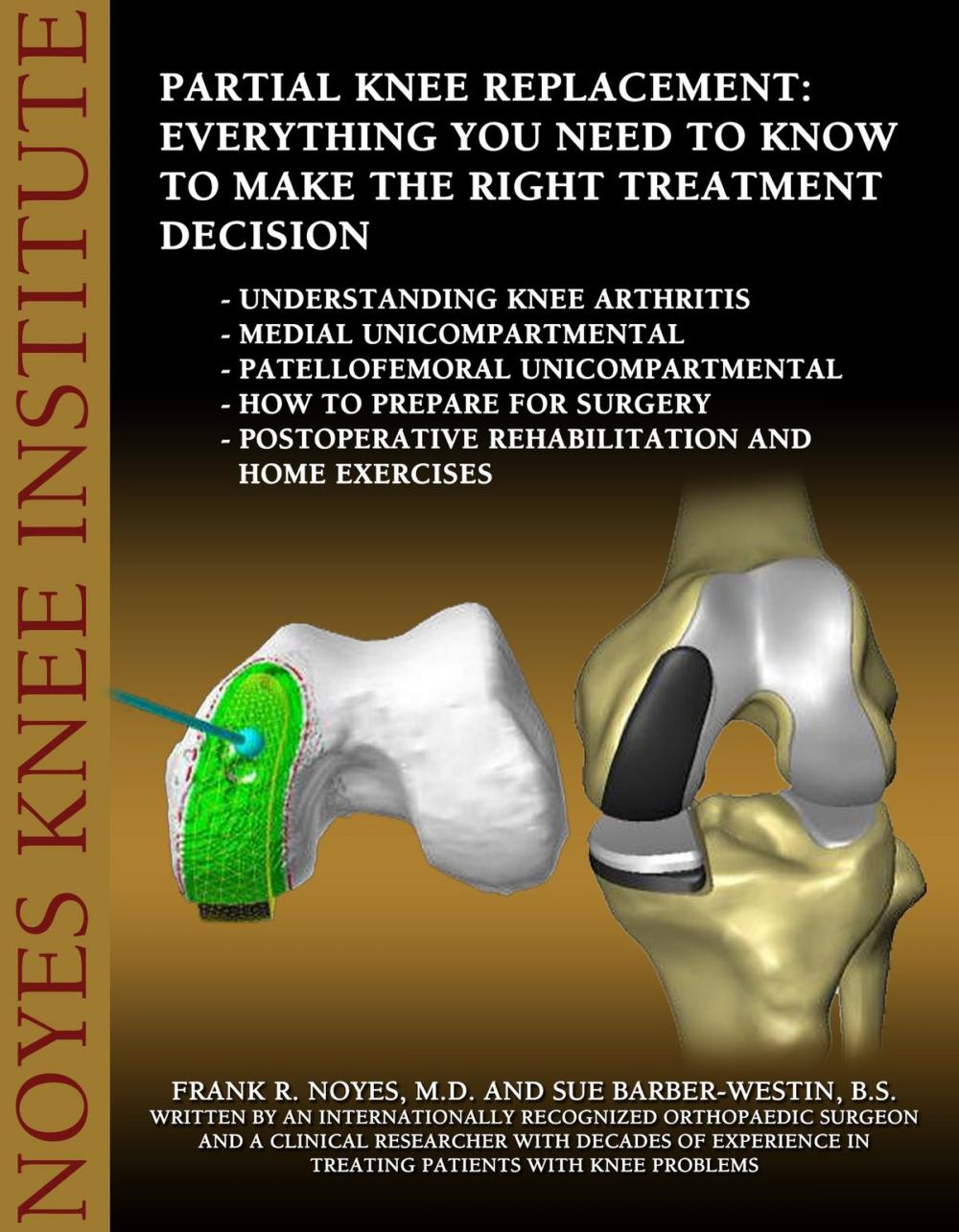 Big bigCover of Partial Knee Replacement: Everything You Need to Know to Make the Right Treatment Decision