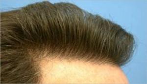 Cover of Hair Transplant Surgery: Everything You Need To Know Prior To Getting Hair Transplant Surgery