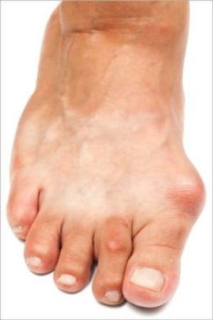 Cover of the book How To Get Rid Of Bunions by Gene Wagner