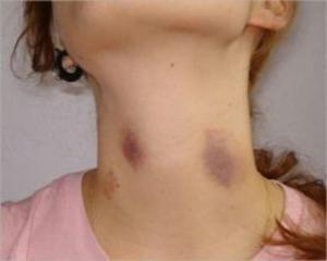 Cover of the book How To Get Rid of Hickies by Theresa Dufrane