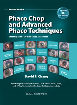 Cover of Phaco Chop and Advanced Phaco Techniques