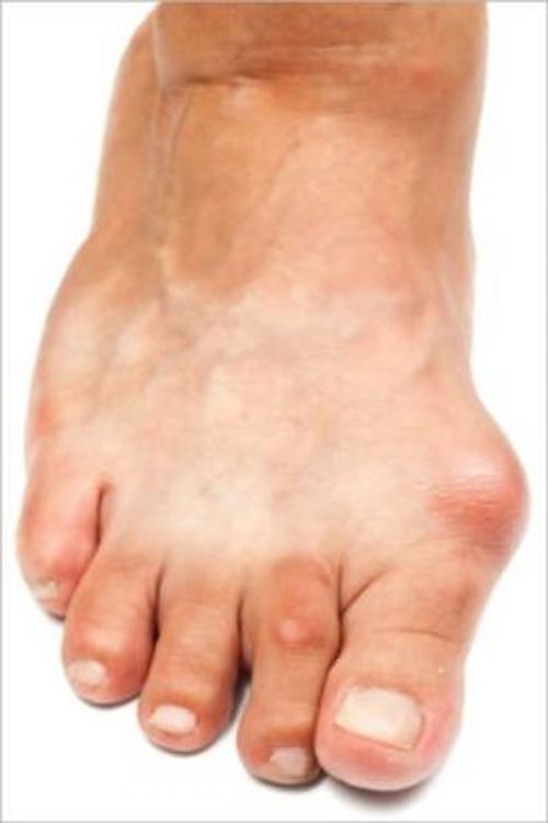 Cover of the book How To Get Rid Of Bunions by Perry Aguilar, Axel Publishing