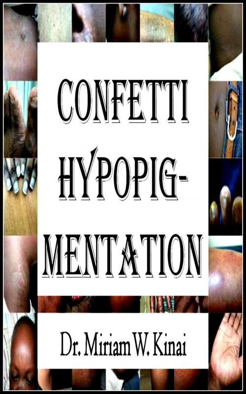 Cover of the book Confetti Hypopigmentation by Miriam Kinai, Miriam Kinai