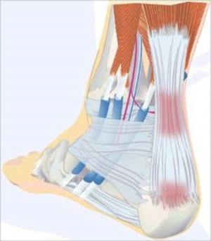 Cover of Achilles Tendinitis: Causes, Symptoms and Treatments